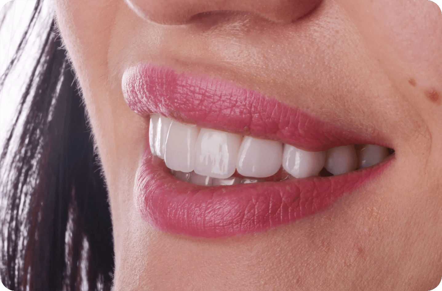 dental crowns and veneers